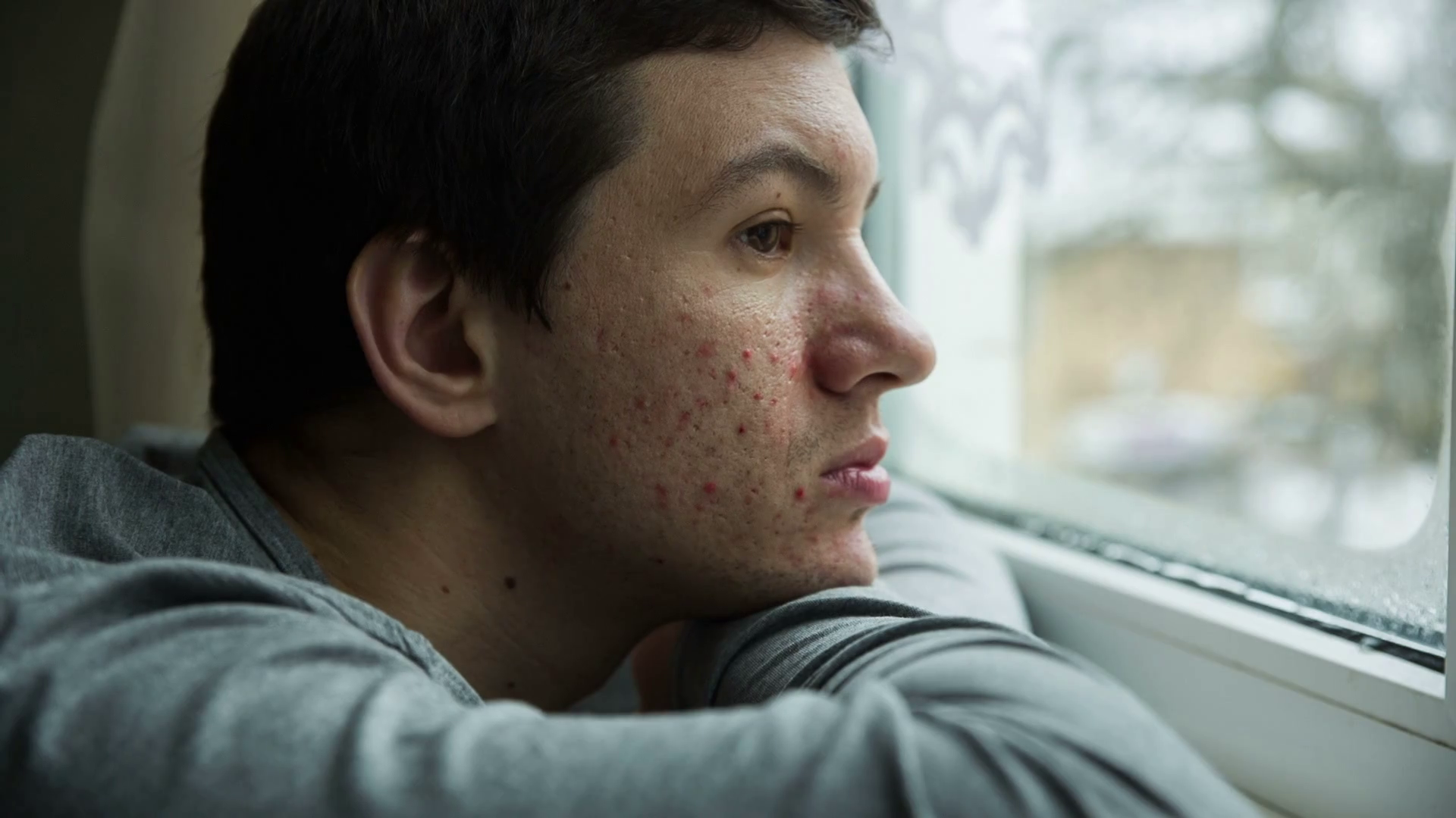 Acne on a face of a man Stock Video Footage Storyblocks