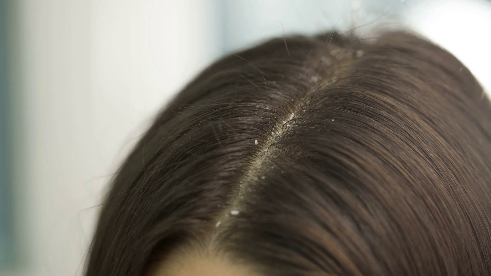 Woman Scratching Hair On Head With Dandruff Stock Footage SBV309911841