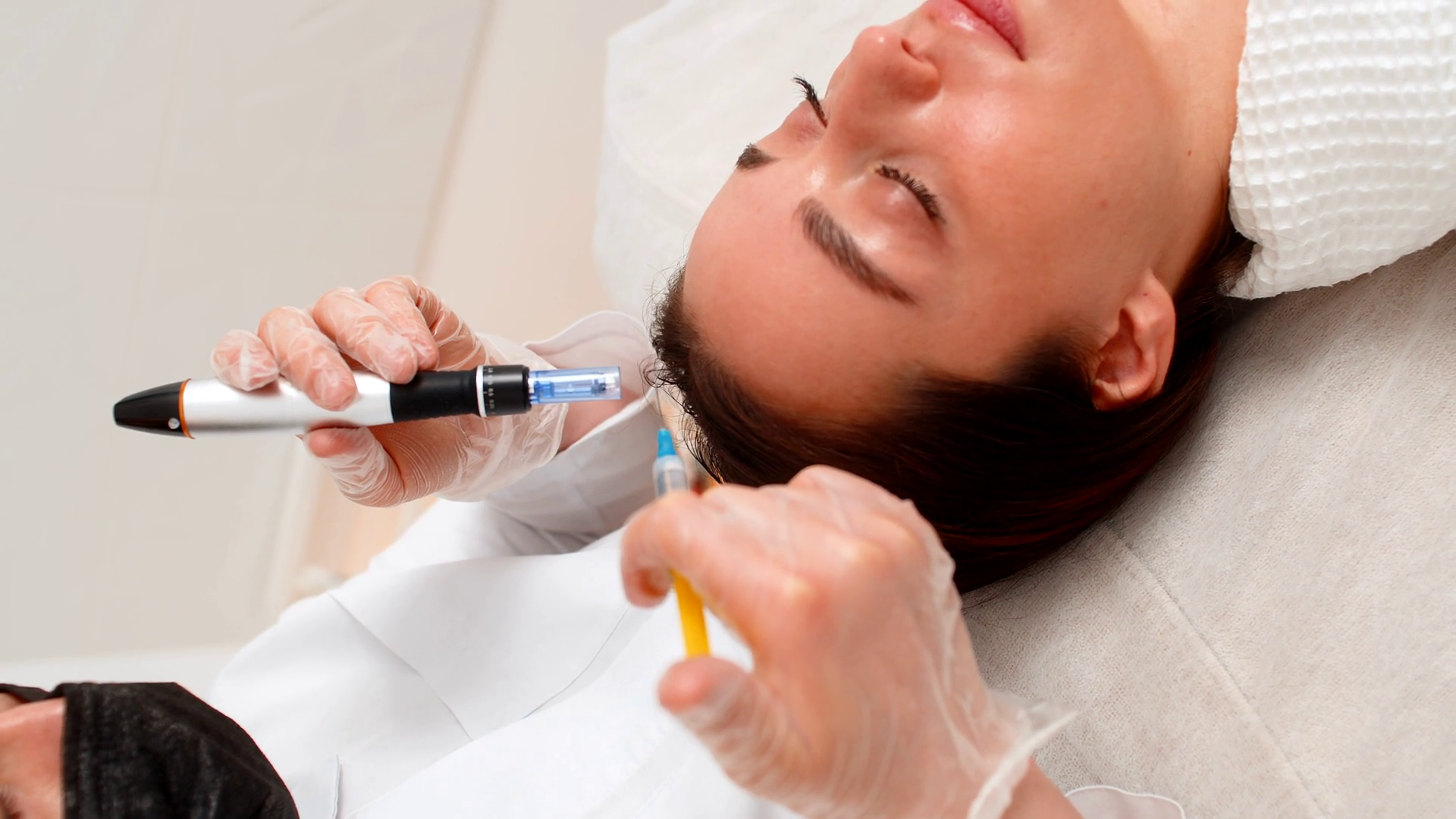 Woman Receives Microneedling Injections Hair Stock Footage SBV ...