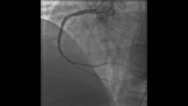 Heart Catheter Stock Footage: Royalty-Free Video Clips - Storyblocks