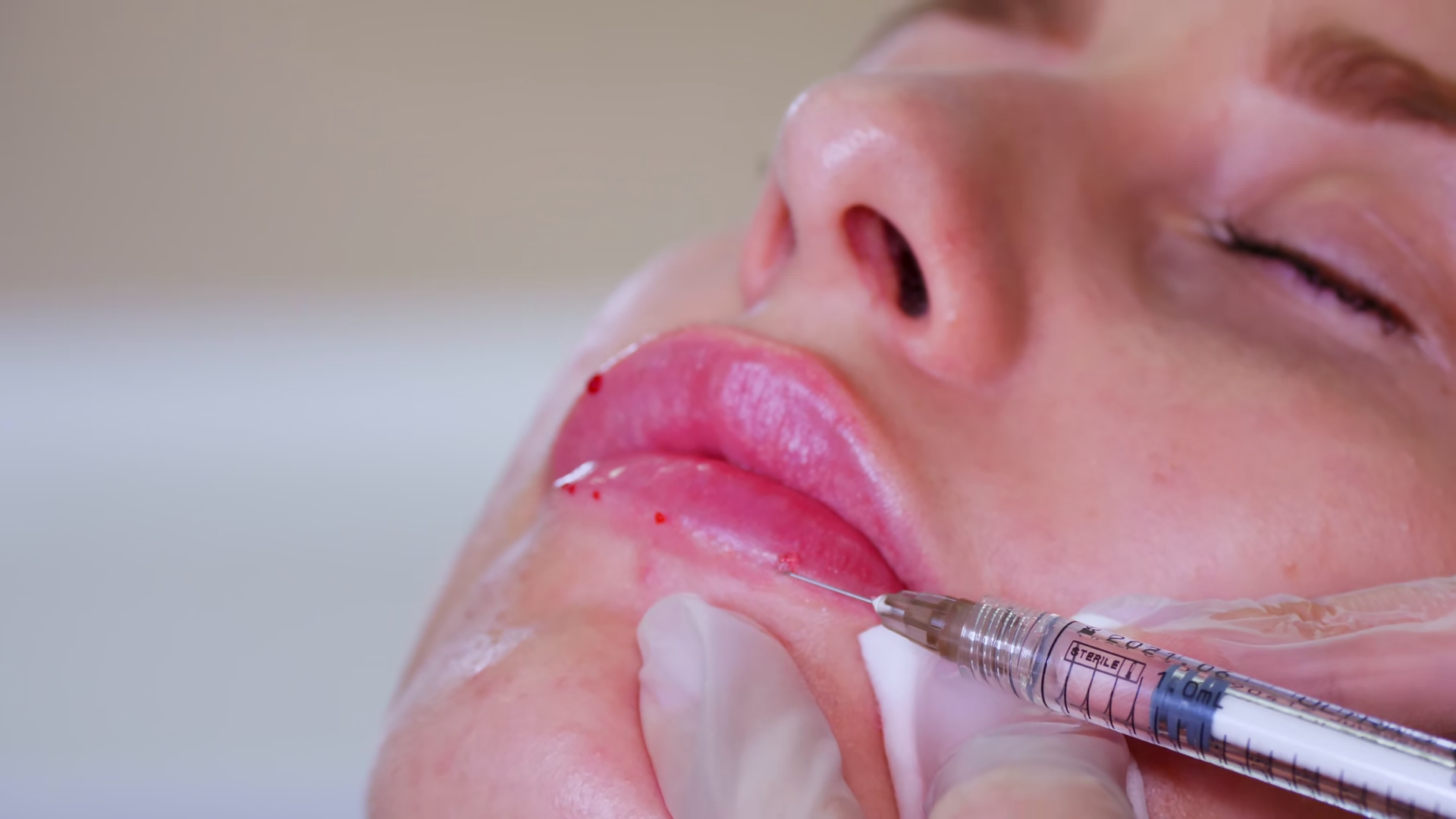 Surgeon Injecting Hyaluronic Acid Filler Stock Footage SBV-353633619 ...