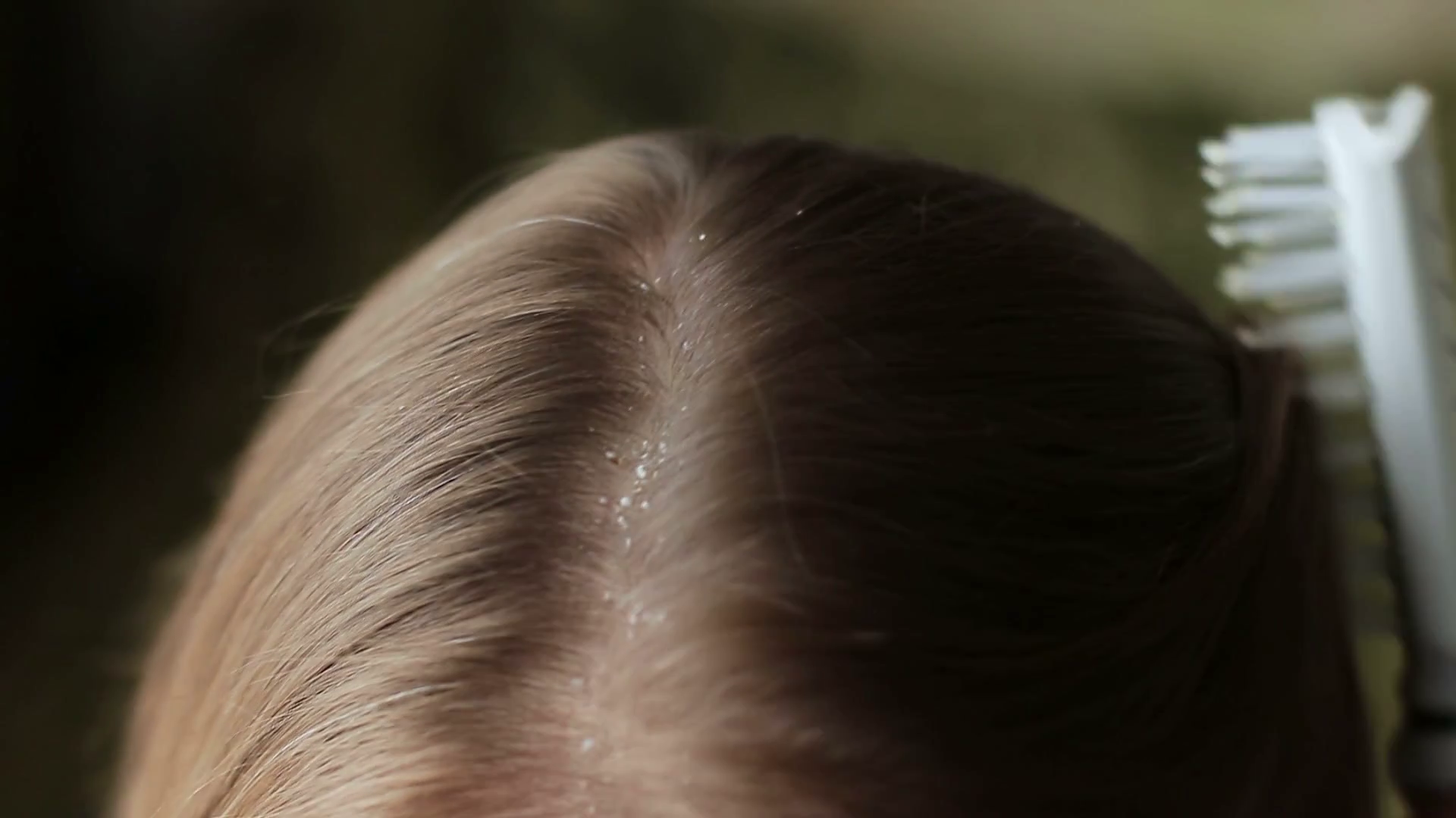 Dandruff Greasy Hair On Head Of Adult Female Stock Footage SBV