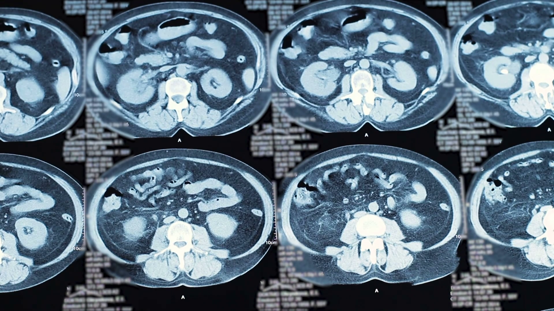 resonance imaging. stones in the kidneys. Close up Stock Video