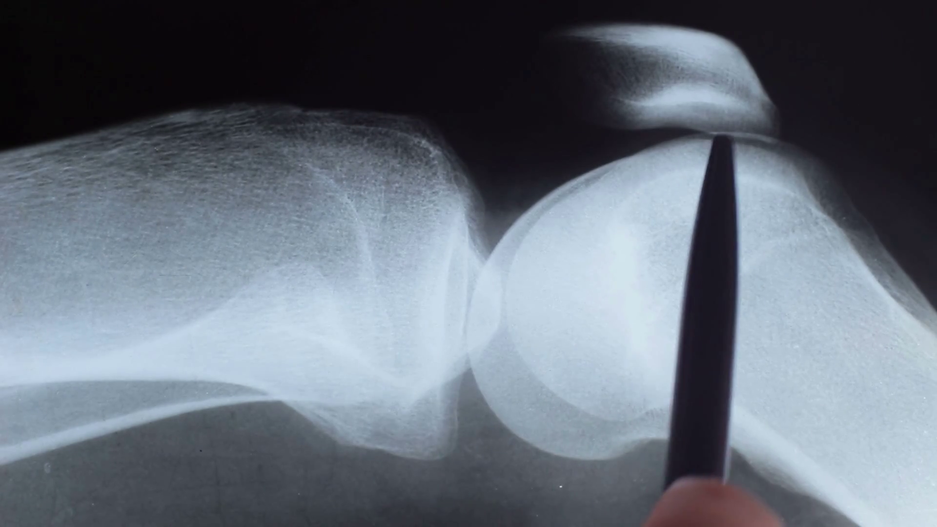 MRI of knee injury. Tumor, rupture of ligaments of the knee joint Motion Background Storyblocks