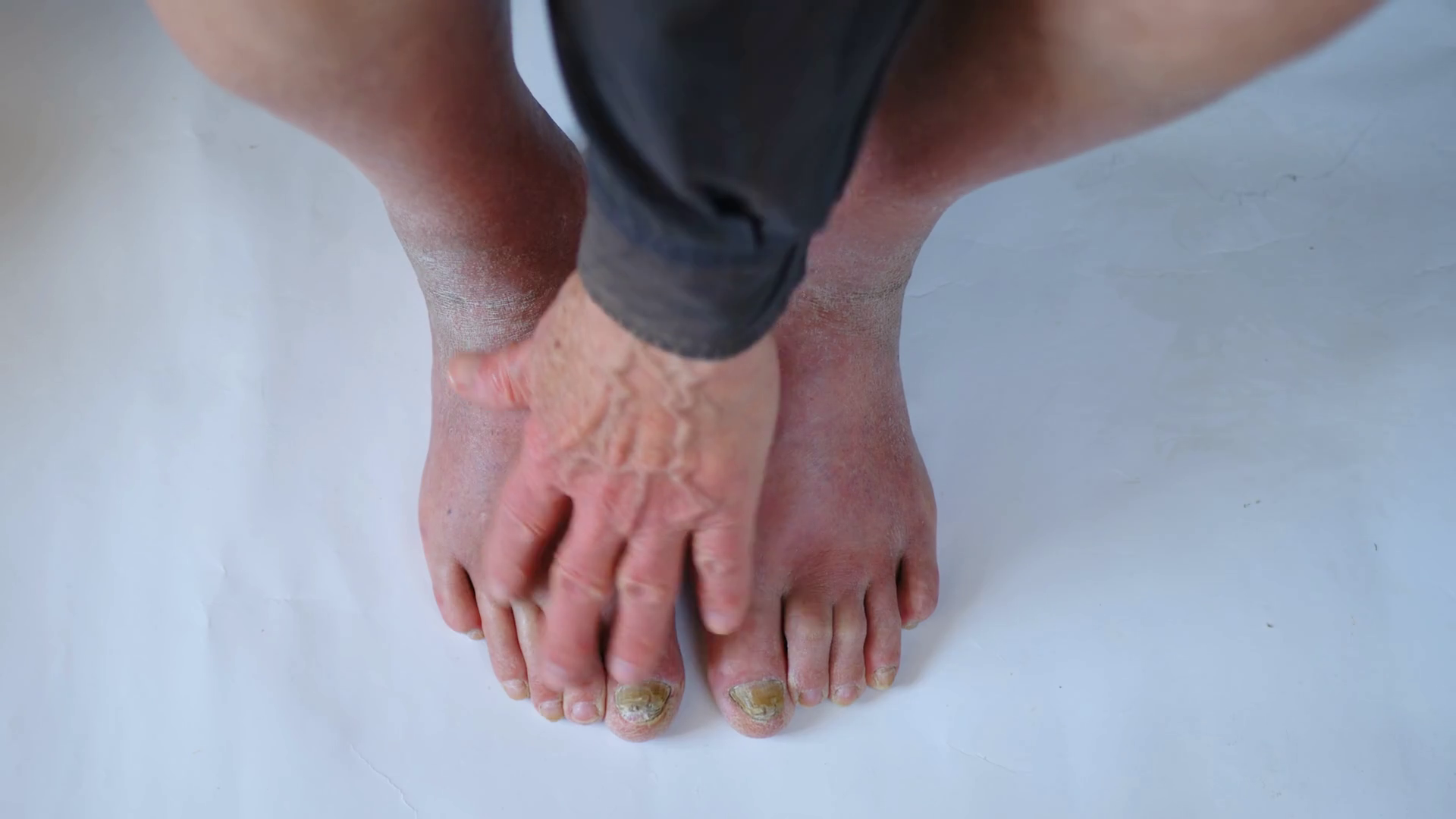 Closeup Of Foot With Damaged Nails Of Fungus Stock Footage SBV