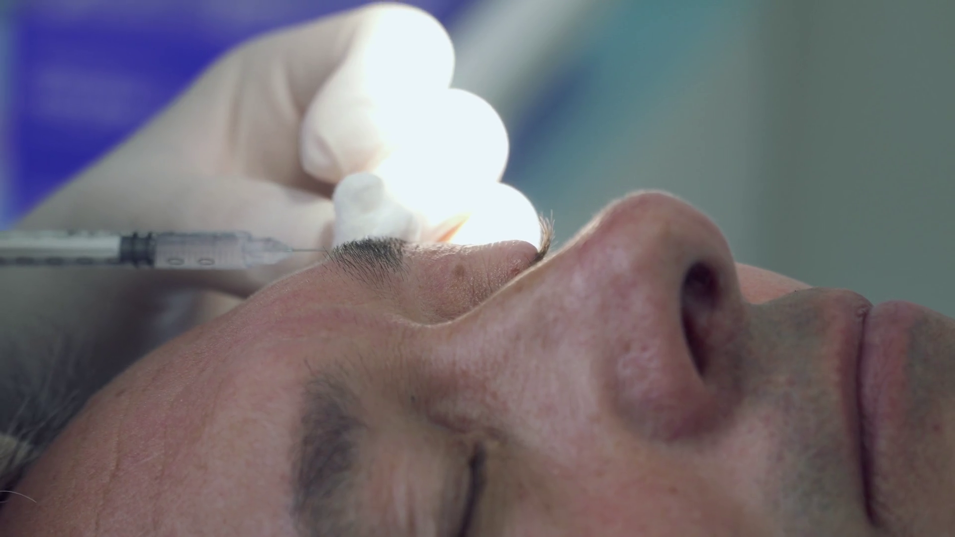 Dermatologist burning mole with laser at the eyelid of patient Stock