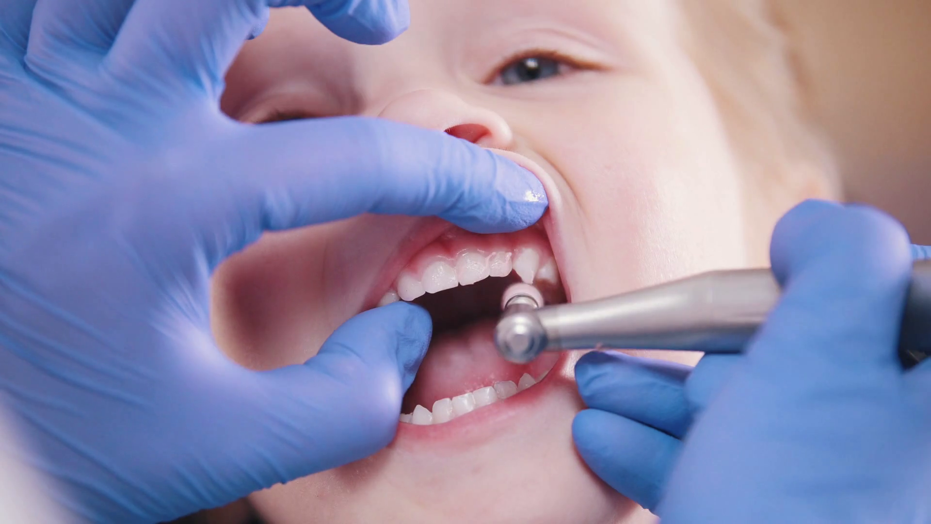 Dentistry Female Dentist Polishing Teeth Of Stock Footage SBV328992216 Storyblocks