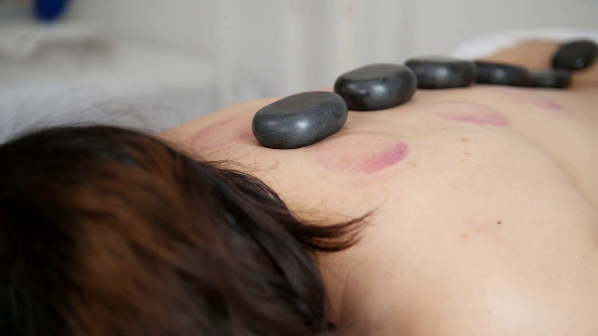 Stones On Back Of Girl In Physiotherapy Room Stock Footage SBV ...