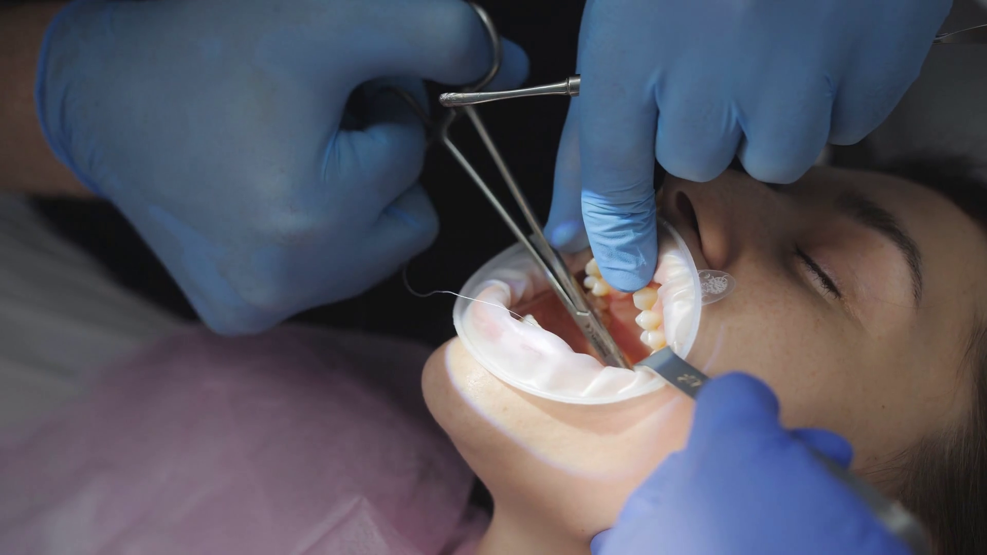 The Dentist Sutures Gum At Site Of Removed Stock Footage SBV346986019 Storyblocks
