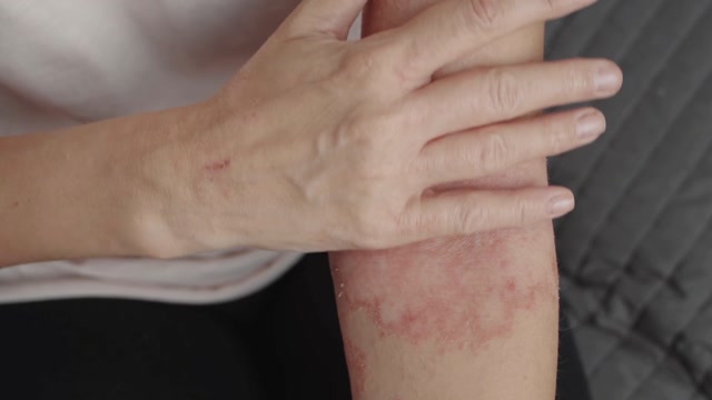 Skin Rash Stock Footage: Royalty-Free Video Clips - Storyblocks