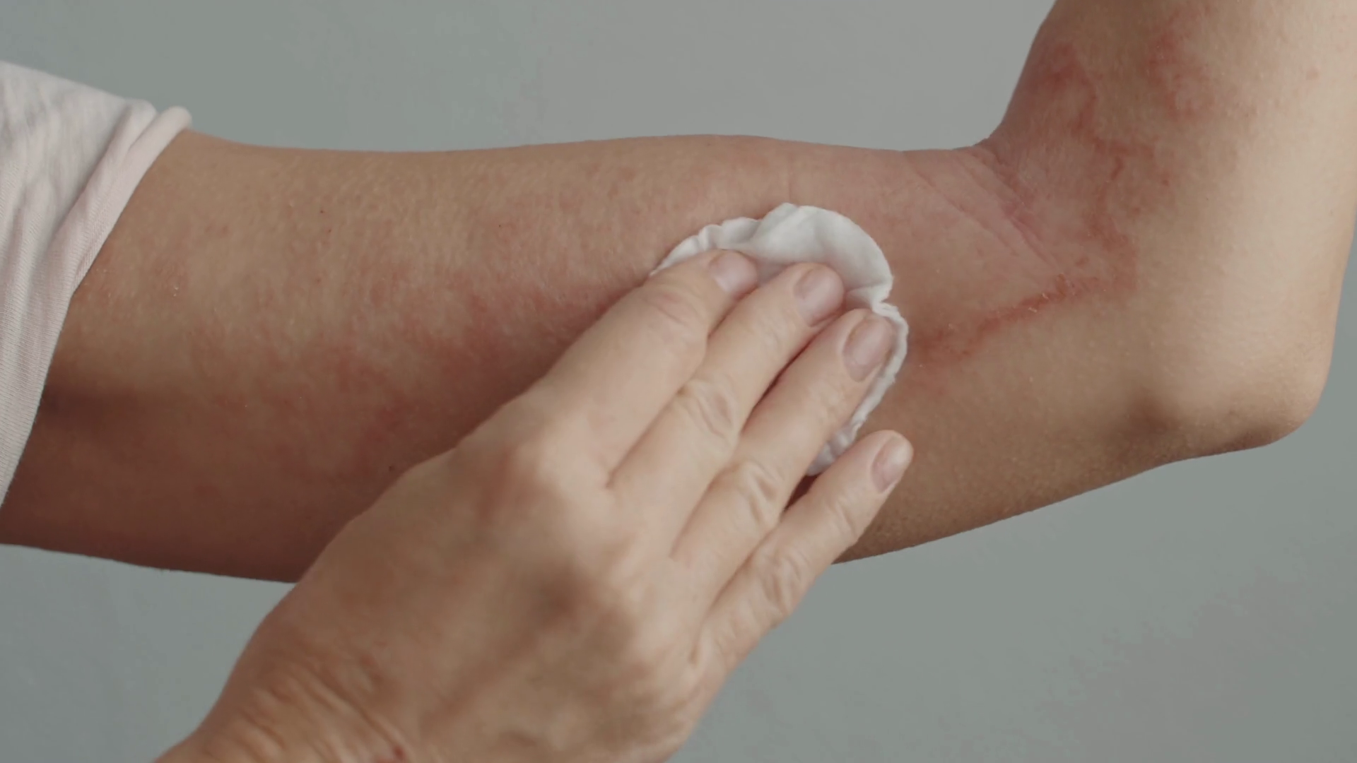 woman with dermatitis using treatment solution Stock Video Footage ...