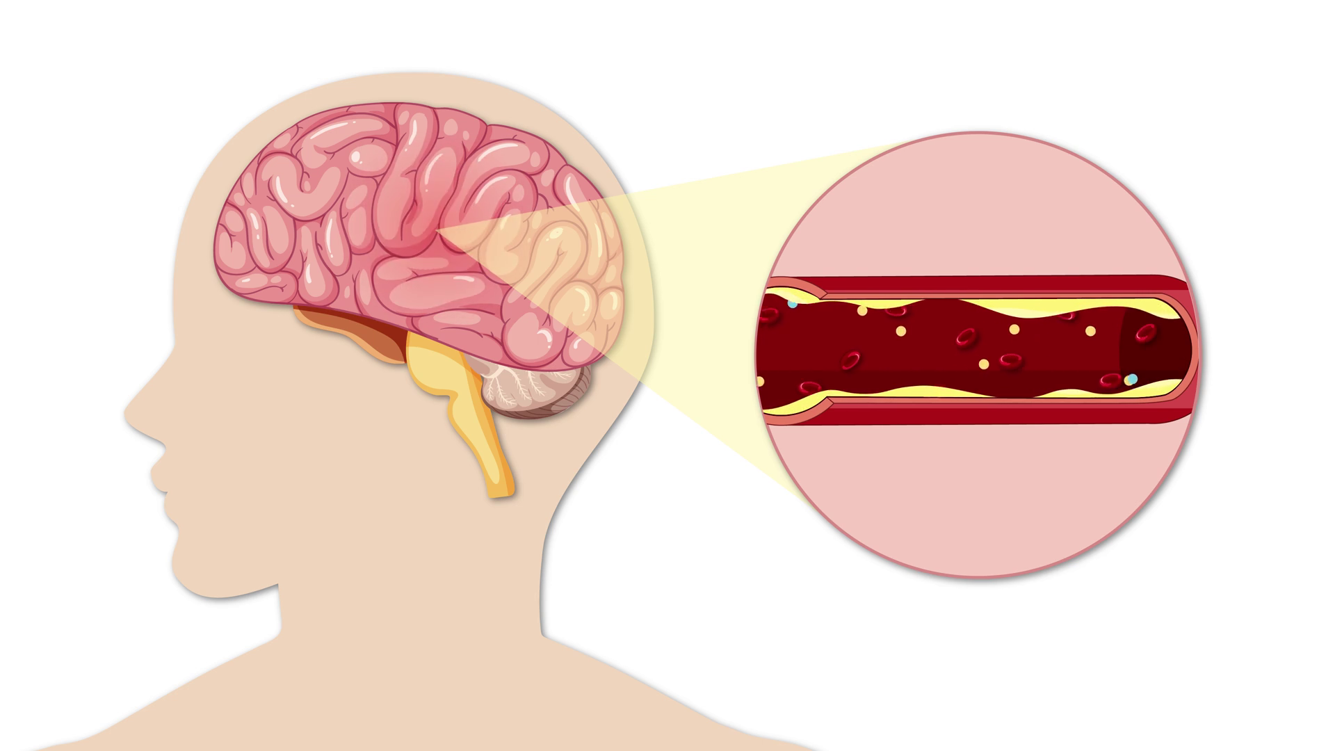 Atherosclerosis Progression In Brain Stock Footage SBV-352402594 ...