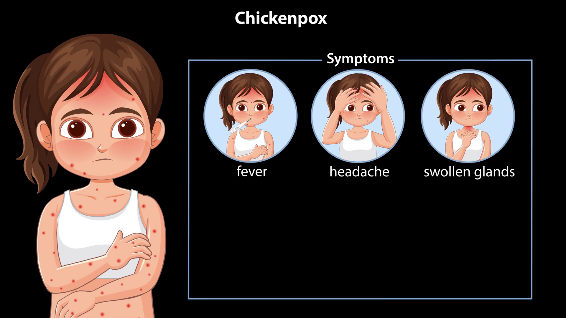 Animated Guide To Chickenpox Symptoms In Stock Footage SBV-352903516 ...