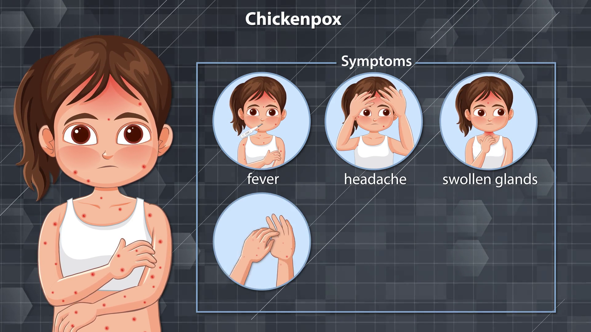 Animated Guide To Chickenpox Symptoms In Stock Footage SBV-352831557 ...