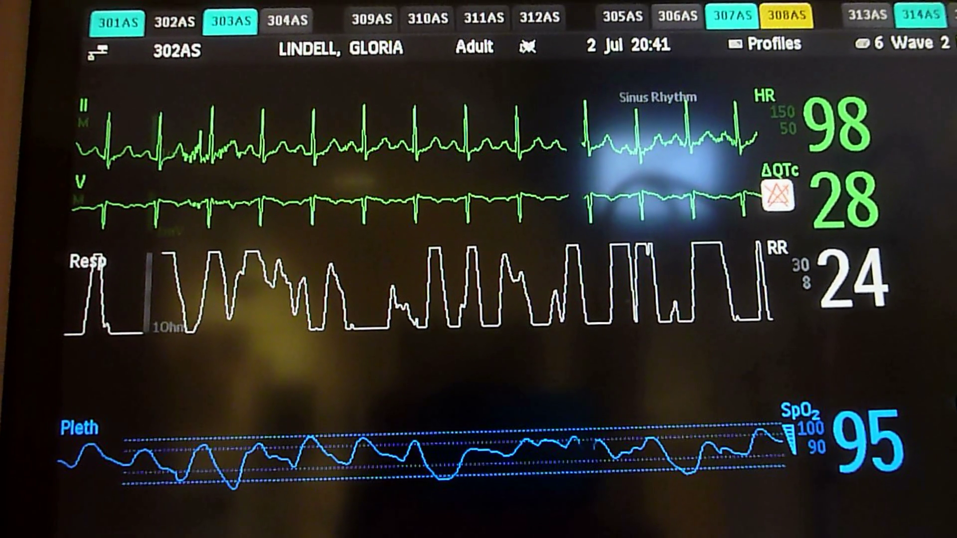 Heart Monitor In ICU Stock Video Footage Storyblocks