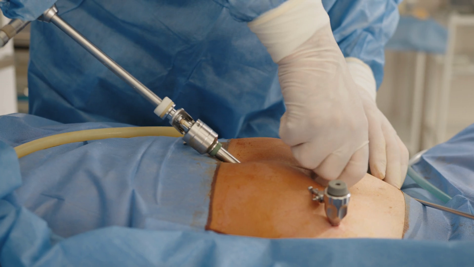 In Operating Room Doctor Does Laparoscopy Stock Footage SBV348507504