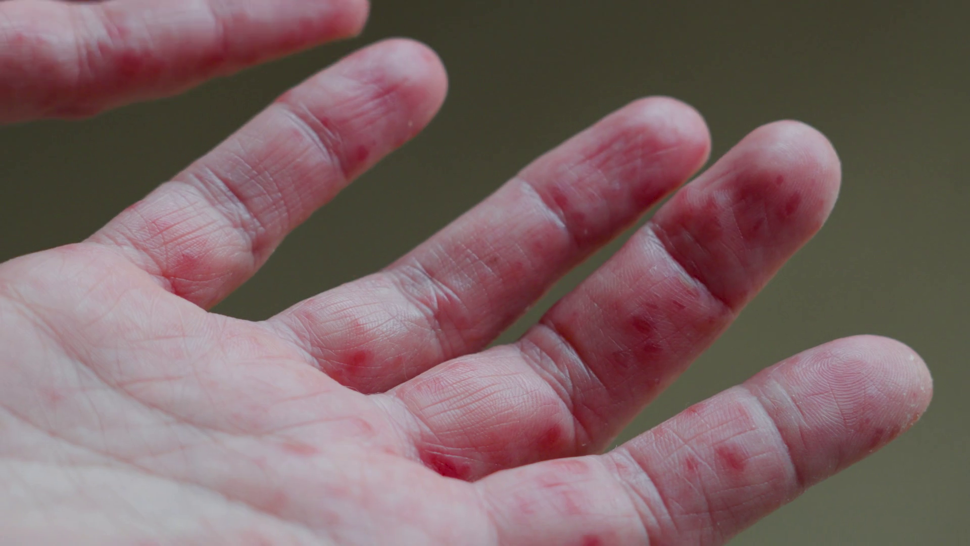 Understanding Different Skin Conditions On Stock Footage SBV-352281012 ...