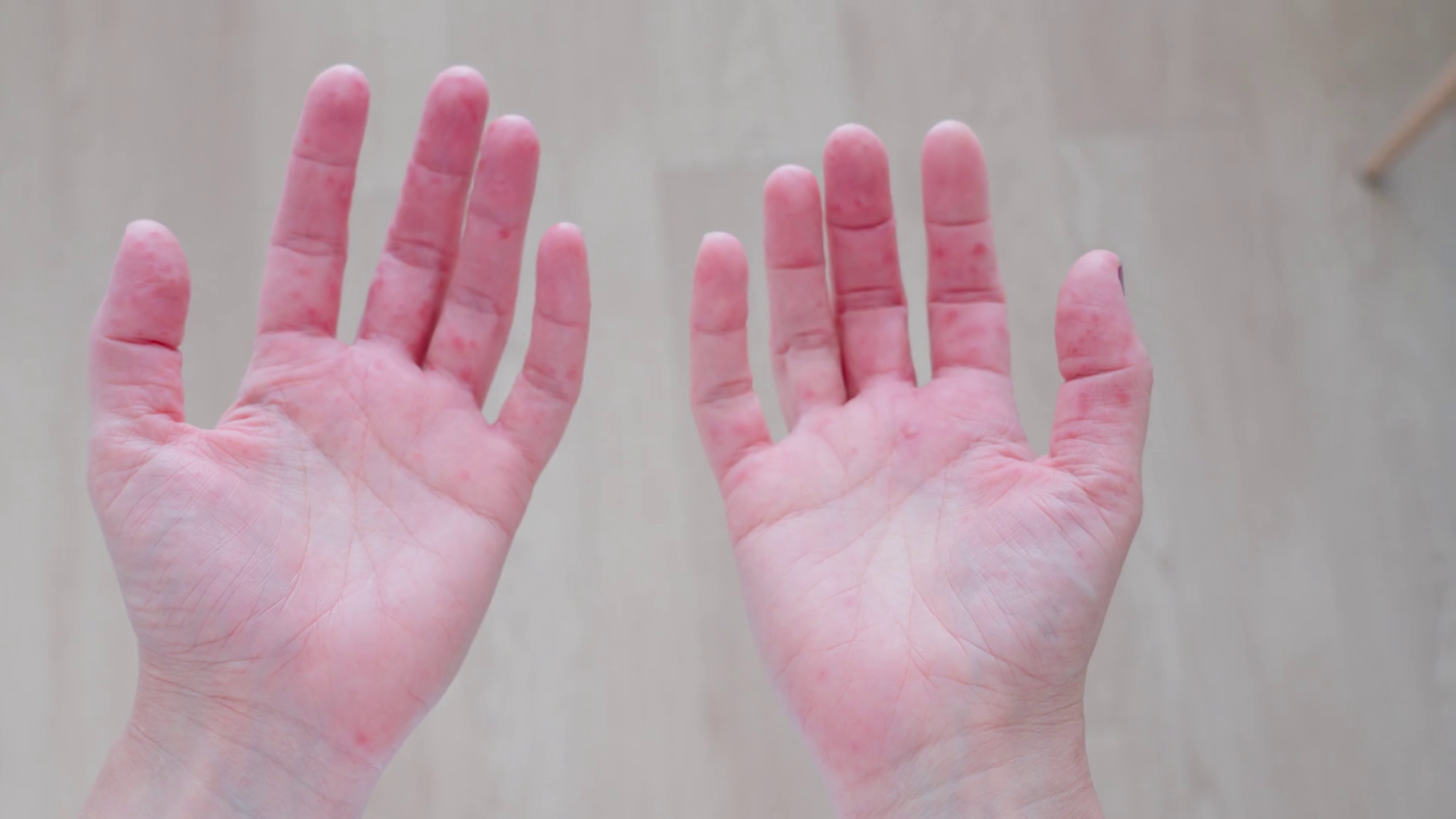 Understanding Hand Rashes Causes Eczema Stock Footage SBV-352280901 ...