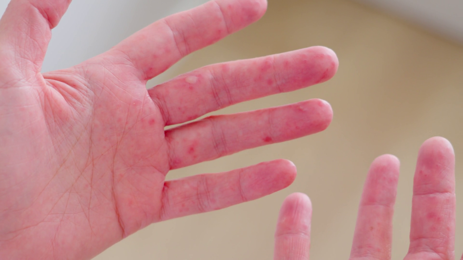 Understanding Skin Rashes From Chickenpox To Stock Footage SBV ...