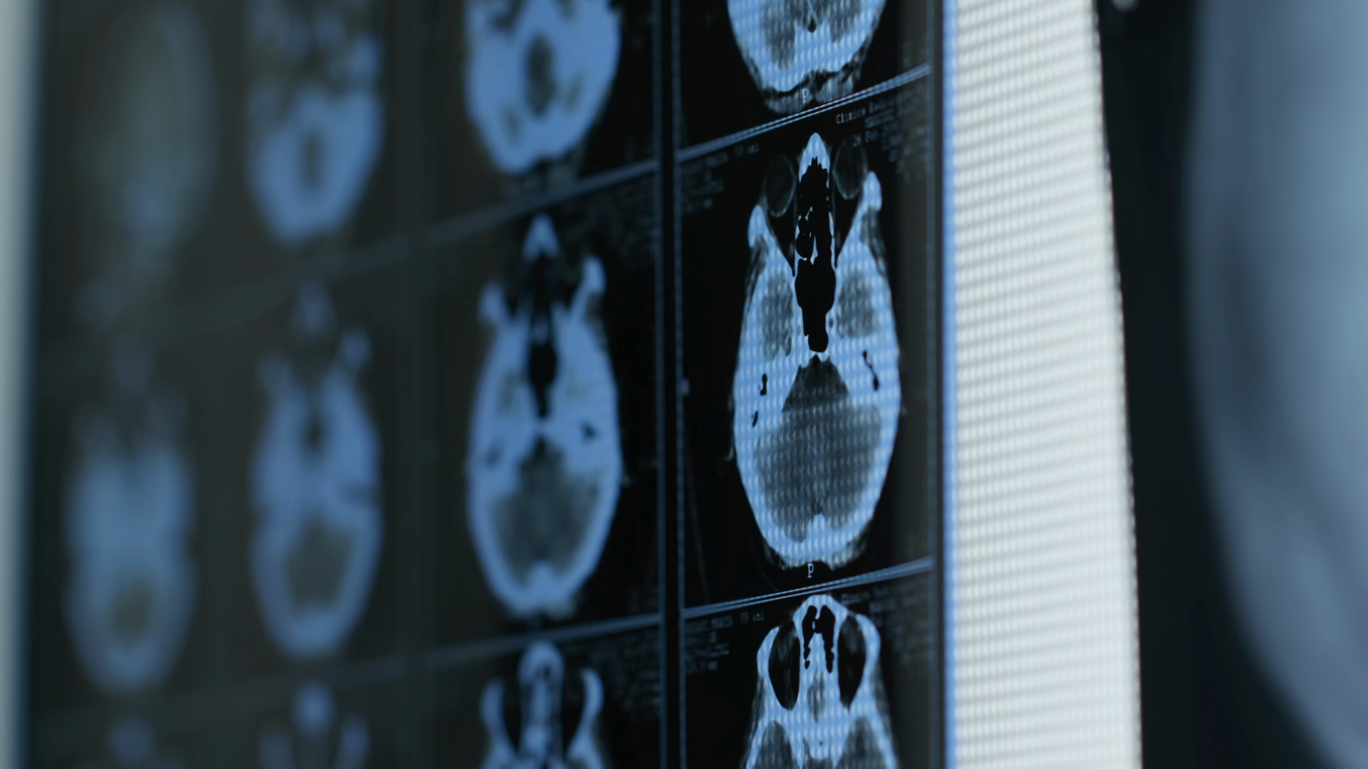 Close Up Of Brain Ct Scan Stock Footage SBV-354015786 - Storyblocks