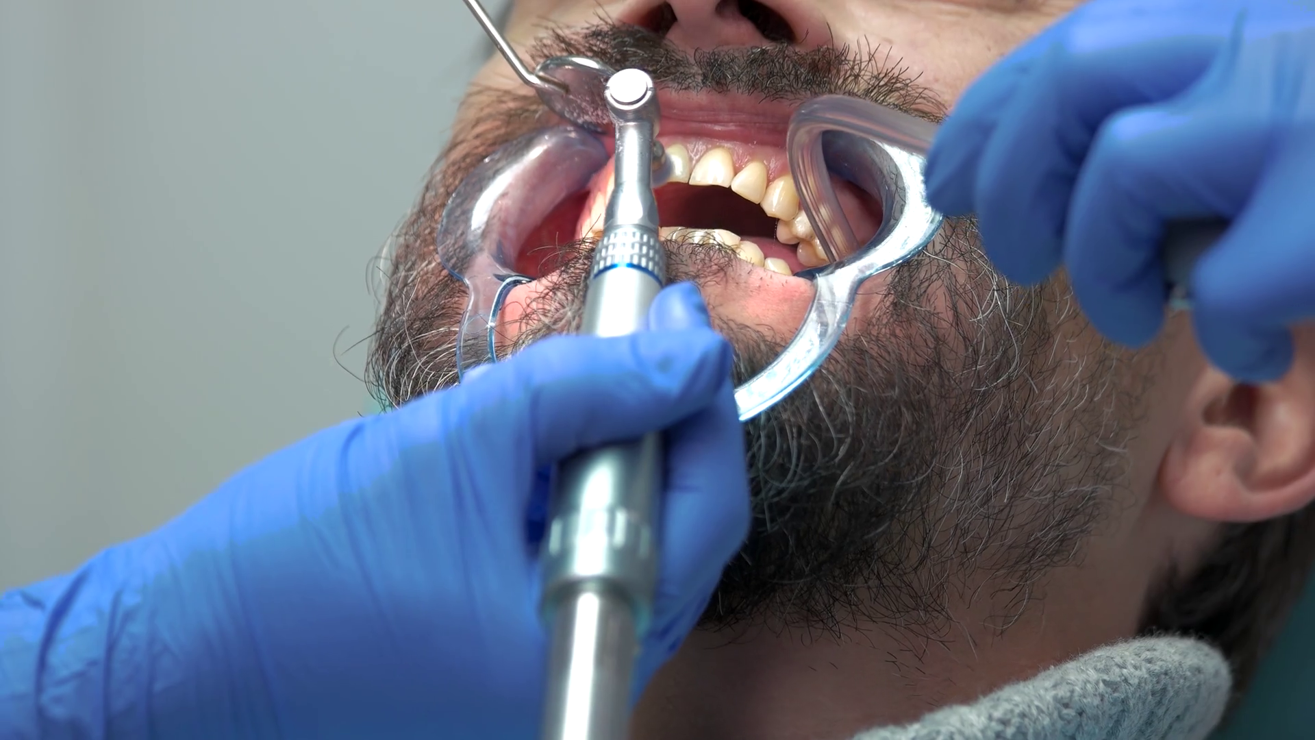 Dentist Brushing Teeth Close Up Dental Cheek Stock Footage SBV