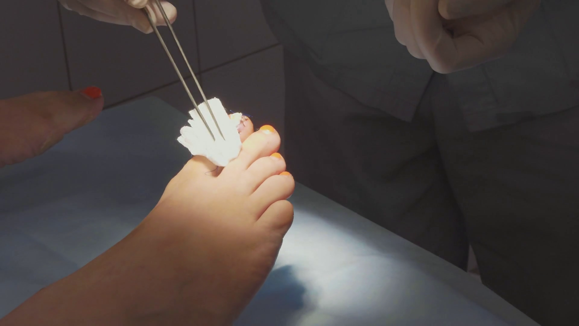 Cleaning Bandaging Procedure Surgery Wound Stock Footage SBV318193532