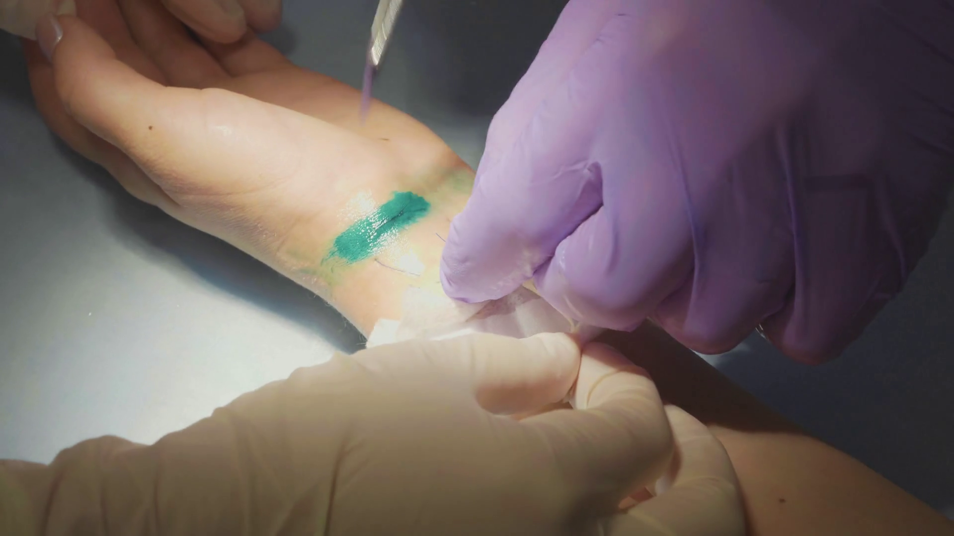 Close-up Doctor Removes Stitches Bandage Arm Stock Footage SBV ...